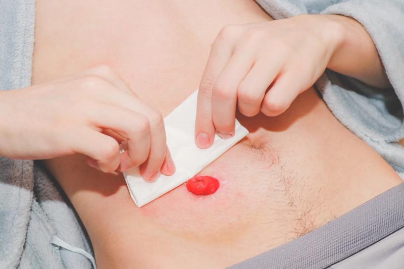 Living With a Stoma: Finding Comfort in a New&nbsp;Norm